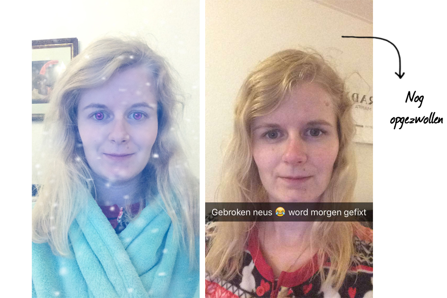 Ik heb mezelf een gebroken neus geslagen