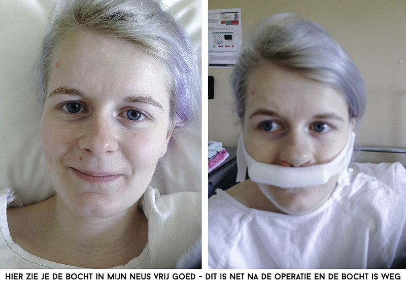 operatie aan neus